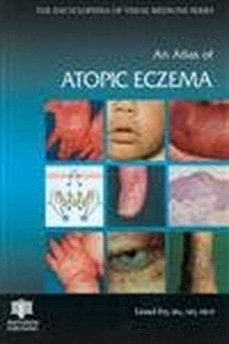 An Atlas of Atopic Eczema