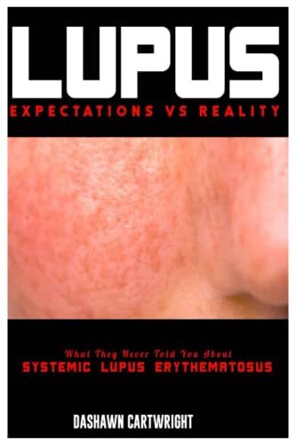 LUPUS EXPECTATIONS VS REALITY: What They Never Told You About Systemic Lupus Erythematosus