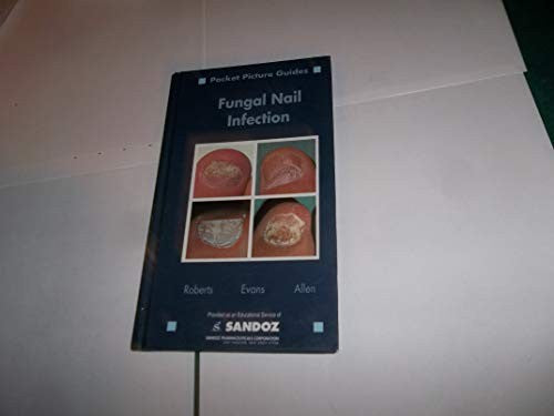 Fungal Nail Infection (Pocket Picture guides)