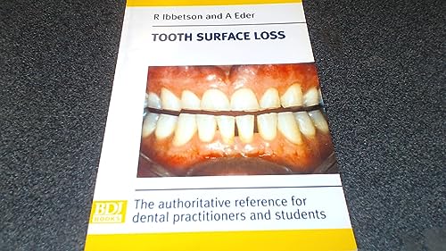 Tooth Surface Loss