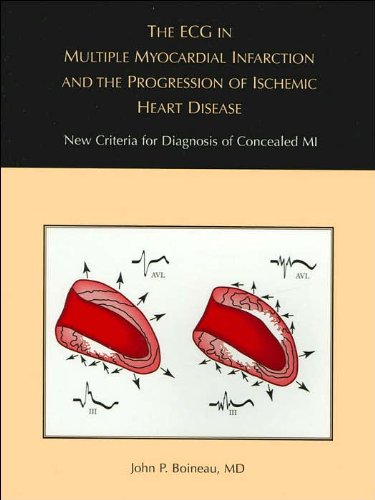 The ECG in Multiple Myocardial Infarction and the Progression of Ischemic Heart Desease - New Criteria for Diagnosis of Concealed MI (Volume 1)