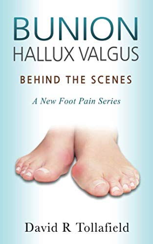 Bunion (Hallux valgus): Behind the Scenes: Foot Pain Series