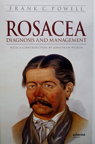Rosacea