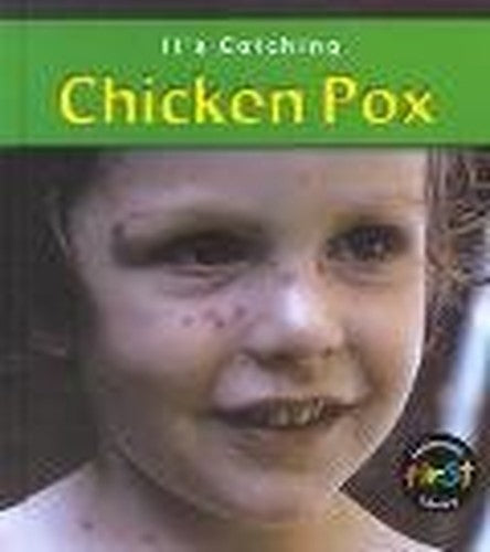Chicken Pox