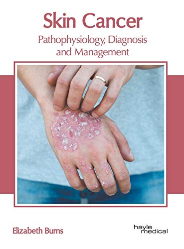 Skin Cancer: Pathophysiology, Diagnosis and Management By Elizabeth ...