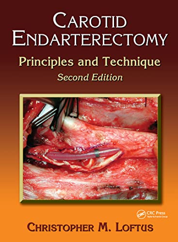 Carotid Endarterectomy